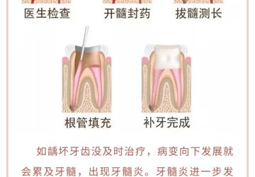【口腔科普】補(bǔ)牙為什么不能一次性完成呢？