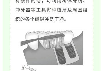 您的種植牙正確維護(hù)了嗎？